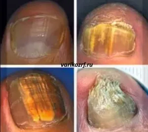 Gombák köröm