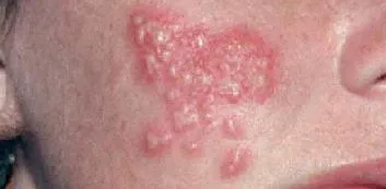 Herpes az arcon fotó kezelést otthon, gyorsan és hatékonyan