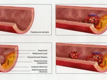 Stroke és annak következményei