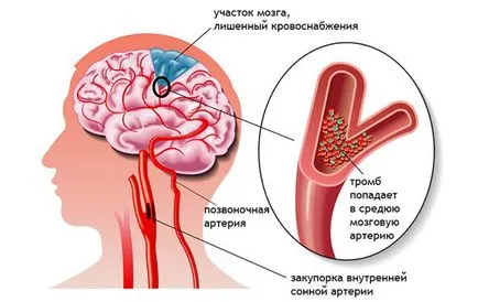 Stroke és annak következményei