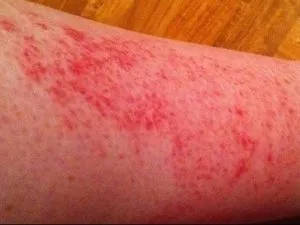 Hogyan kell kezelni a irritáció után szőrtelenítés (irritáció) Hogyan kell kezelni a irritáció után szőrtelenítés