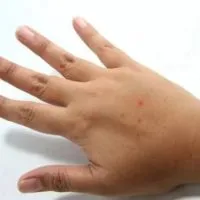 Hogyan juthat el a kullancs az emberi alkalmazkodás és azt kéznél