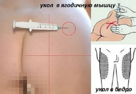 Hogyan készítsünk egy injekciót izomba (jobbra) Hogyan készítsünk egy injekciót izomba