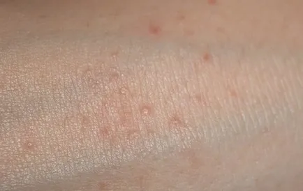 Hogyan allergia háztartási vegyszerek emberekben, stop allergia