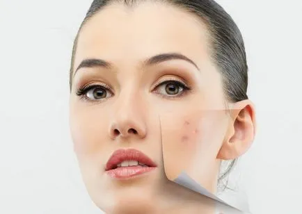 Hogyan lehet eltávolítani a foltokat után akne hámlani kezd, savak, badyaga, maszk (acne) Hogyan lehet eltávolítani a foltokat után akne hámlani kezd, savak, badyaga, maszkok