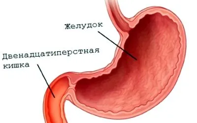 дуоденіт