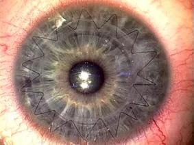 Keratoconus - okai, tünetei és kezelése