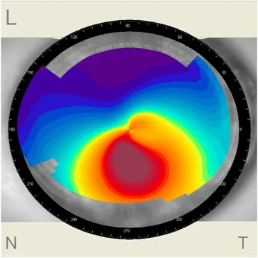 Keratoconus - okai, tünetei és kezelése