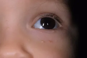 Molluscum contagiosum - kezelés gyermekek és felnőttek, és a hagyományos népi módon (kagyló) Molluscum contagiosum - kezelés gyermekek és felnőttek, és a hagyományos népi módon