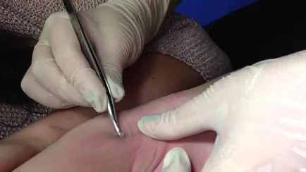 Molluscum contagiosum kép, tünetek, kezelés otthon, lézeres abláció (fertőző) Molluscum contagiosum képeket, tünetek, kezelés otthon, lézeres eltávolítása