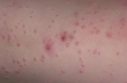 Molluscum contagiosum kép, tünetek, kezelés otthon, lézeres abláció (fertőző) Molluscum contagiosum képeket, tünetek, kezelés otthon, lézeres eltávolítása