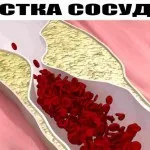 Visszértágulatok kezelésében népi orvosság - hogyan lehet megszabadulni a visszerek otthon