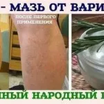 Visszértágulatok kezelésében népi orvosság - hogyan lehet megszabadulni a visszerek otthon