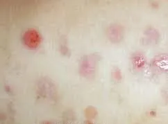 streptococcus kezelése népi jogorvoslat