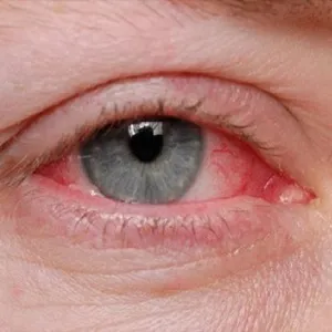 A kezelés és az allergiás tünetek a fahéj - szól allergiák (fahéj) Kezelés és allergia tünetei fahéj - szól allergia
