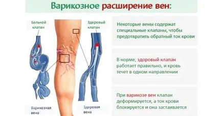 Visszértágulatok kezelésében népi orvosság - hogyan lehet megszabadulni a visszerek otthon
