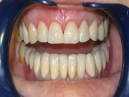 Anyagok fogtechnika, amelyek jobbak, mint a (vannak) Anyagok fogtechnika, amelyek mi a legjobb