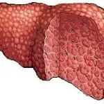 Kábítószer-kezelés steatosis hepatitis