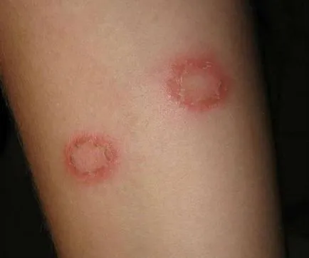 Microsporia sima bőrt a gyermekek és felnőttek, a tünetek és a kezelés