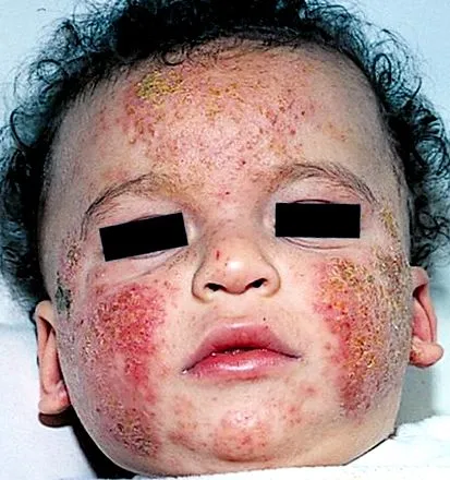 dermatitiszről alapvető