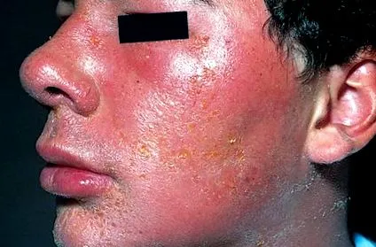 dermatitiszről alapvető