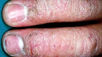 dermatitiszről dermatitiszről
