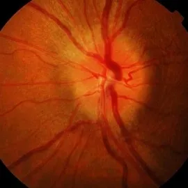Látóideg-gyulladás tünetei, kezelése és típusú okuláris neuritis (vizuális) Látóideg-gyulladás tünetei, kezelése és típusú okuláris neuritis