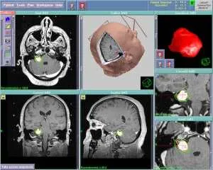 Nincs szükség, hogy végezzen craniotomy 