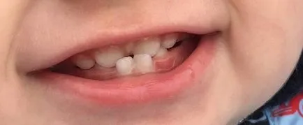 Malocclusion a gyermek - hogyan lehet azonosítani, és gyógyítja a (rossz) Malocclusion a gyermek - hogyan lehet azonosítani és kezelni