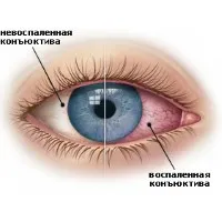 Eye Clinic - excimer felülvizsgálat, ár, vélemények