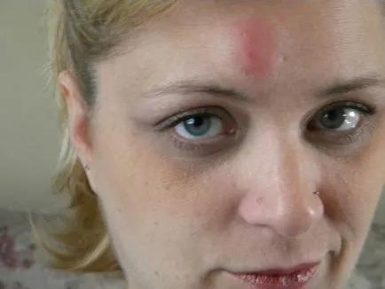 Mit jelentenek a pattanások az arcon pattanások kártya (acne) Mit jelentenek a pattanások az arcon pattanások kártya