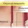 Sensation egy csomót a nyelőcső okok és a kezelés a tünetek (érzés) Sensation egy csomót a nyelőcső okoz tüneteket és a kezelés