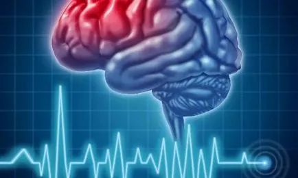Szövődmények stroke-ot követő korai és késői