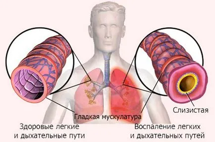 Szövődmények: vérzéses stroke típusú támadások és azok részletes elemzése