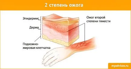 Scorch olaj kezelése, mint egy égési folyamat a fluidizált növényi olaj (égnek) Burn olajos kezelés, mint égések a forró olajban