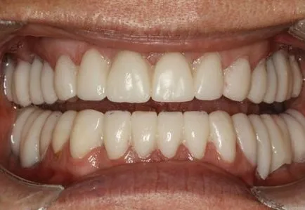 Elutasítása fogászati ​​implantátumok - tünetek, panaszok okai