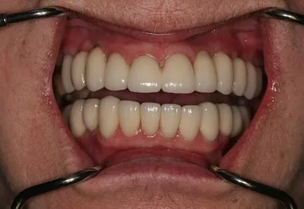 Elutasítása fogászati ​​implantátumok - tünetek, panaszok okai