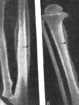 hyperostosis