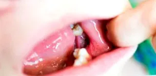 alveolitis telepítését