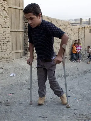 Polio esetek gyermekek fotó, jellemzői és okai A betegség szövődményei polio gyermekeknél