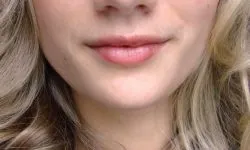 Have mi ugrott a helyszínen a fül vagy a fülcimpa