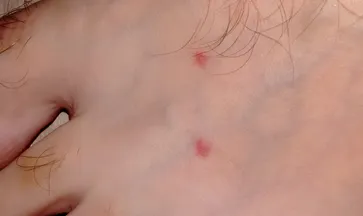 Buborékok a fotó megálló, esetleges betegség, kezelés, gombás betegségek