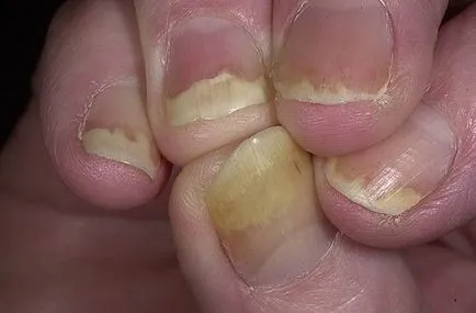 Nail pikkelysömör otthoni kezelés népi jogorvoslat, video tippek (köröm psoriasis: a betegség kezelésében és annak okait) Nail pikkelysömör otthoni kezelés népi jogorvoslat, video tippek