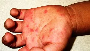 A kiütés enterovirus fertőzés gyermekeknél - a leírás és fotó