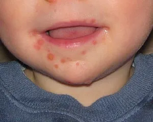 A kiütés enterovirus fertőzés gyermekeknél - a leírás és fotó