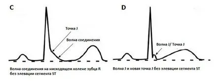 A szindróma korai kamrai repolarizáció mi ez a megnyilvánulása az EKG (korai kamrai repolarizáció) A szindróma korai kamrai repolarizáció mi ez a megnyilvánulása az EKG-n