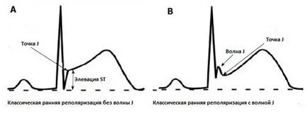 A szindróma korai kamrai repolarizáció mi ez a megnyilvánulása az EKG (szindróma) A szindróma korai kamrai repolarizáció mi ez a megnyilvánulása az EKG-n