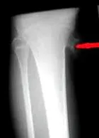osteogén