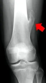 osteogén