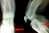 exostosisok